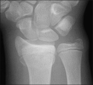 Fracture_Distal radius physeal_Figure 3_1370609-Salter-Harris2_AP.jpg